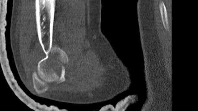 Distal humerus displaced fracture external fixation. Computed tomography scan showing traumatic elbow injury stabilization for medical education orthopedic surgical planning