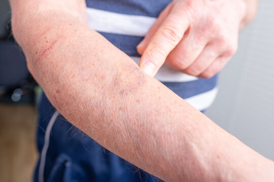 Close up of several red scratches on an adult male's forearm, skin irritation and minor injury caused cat, plants, Physical injury and skin trauma, Dermatological irritation, Pet ownership challenges