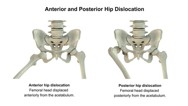 Hip dislocation, 3D illustration comparing anterior and posterior displacement of the femoral head relative to the acetabulum