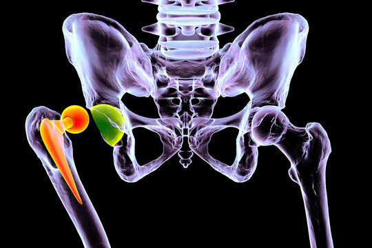 Posterior dislocation of total hip replacement, 3D illustration showing posterior displacement of the prosthetic femoral head from the acetabular component, isolated medical depiction