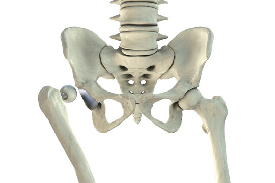 Posterior dislocation of total hip replacement, 3D illustration showing posterior displacement of the prosthetic femoral head from the acetabular component, isolated medical depiction