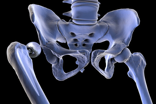 Posterior dislocation of unipolar hip hemiarthroplasty, 3D illustration showing posterior displacement of the prosthetic femoral head from the native acetabulum, isolated medical depiction