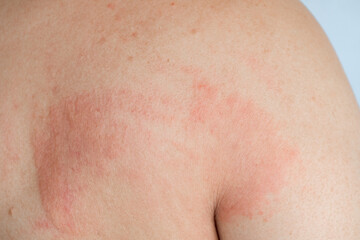 Fototapeta premium Close up of a man with a red skin rash and inflammation on his back. A person scratching an itchy allergic reaction, eczema, or dermatitis on the body. Concept of healthcare and dermatology, urticaria