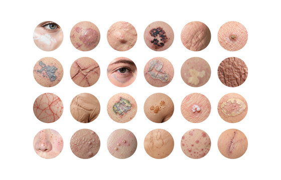 Collection of various skin conditions and dermatological symptoms, ai generated. Detailed dermatology collage multiple skin problems with irritation, dryness, inflammation and texture changes.