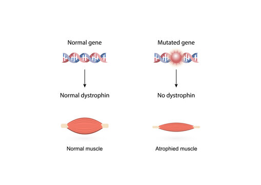 Muscular dystrophy ,MD, Duchenne MD syndrome, mutations in genes responsible for healthy muscle structure and function. Vector illustration.