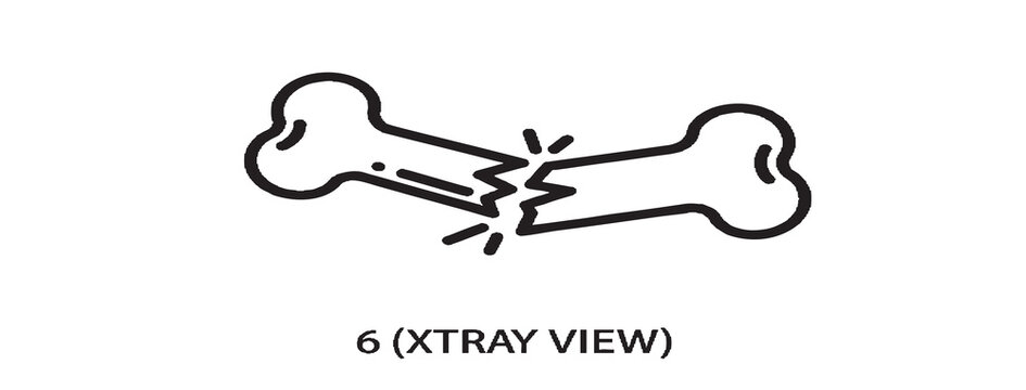 Broken bone fractures in x-ray medical view illustration