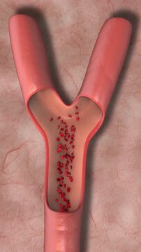 Recombinant Tissue Plasminogen Activator for Clot Dissolution