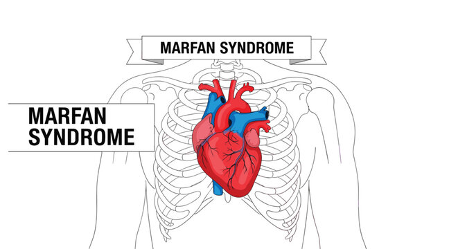 Medical illustration explaining Marfan Syndrome featuring the skeletal chest cavity and a highlighted heart organ.