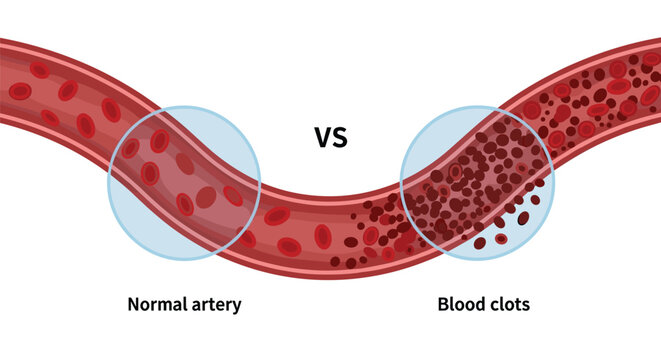 Medical comparison diagram showing the cross-section of a normal artery versus one blocked by red blood clots.