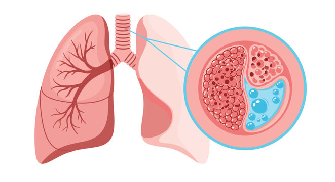 Medical illustration showing human lungs with a detailed inset view of alveoli filled with fluid, representing a respiratory condition.