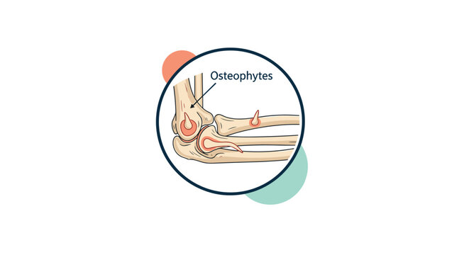 Medical illustration highlighting osteophytes or bone spurs on the human elbow joint to demonstrate joint wear or arthritis.