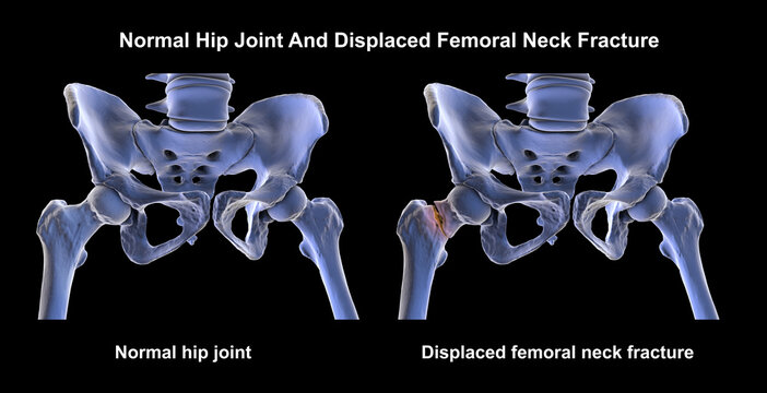 Normal hip joint and displaced femoral neck fracture, 3D illustration