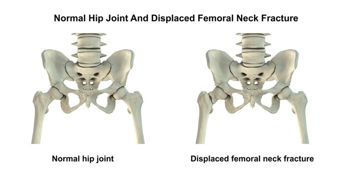 Normal hip joint and displaced femoral neck fracture, 3D illustration
