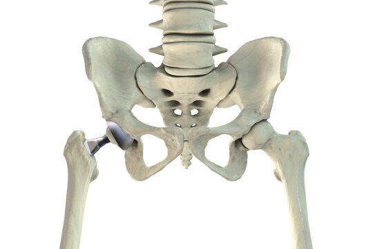 Total hip replacement prosthesis. Shows femoral stem with head, acetabular cup with liner, and articulation in the hip joint. 3D illustration.