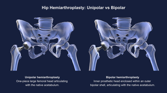 Three types of hip prostheses: unipolar hemiarthroplasty, bipolar hemiarthroplasty and total hip replacement, 3D illustration