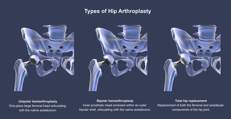Naklejka premium Three types of hip prostheses: unipolar hemiarthroplasty, bipolar hemiarthroplasty and total hip replacement, 3D illustration