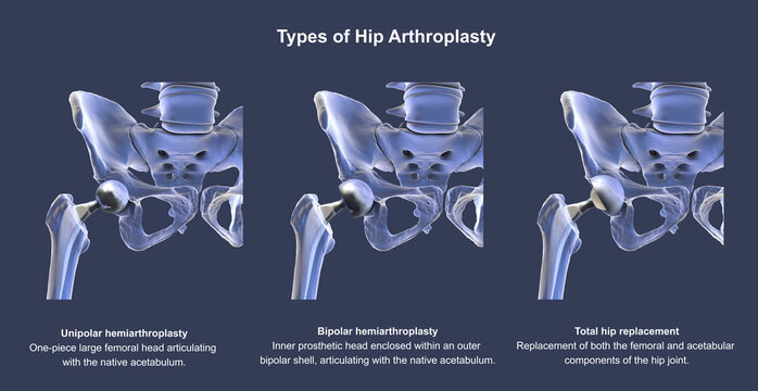 Three types of hip prostheses: unipolar hemiarthroplasty, bipolar hemiarthroplasty and total hip replacement, 3D illustration