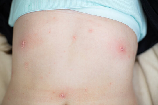 Body showing skin rash blisters chickenpox on stomach
