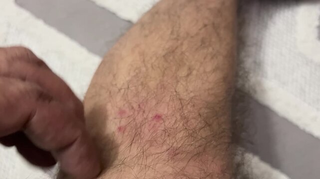 A close-up shot of a person examining itchy red rashes on their leg. A natural image suitable for projects focusing on skin irritation, allergic reactions, or insect bites.