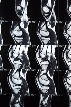 patellofemoral nodular soft tissue thickenings, subcortical marrow edema, contusion of the lower patellar poles, Grade 2 signal of the posterior horn of the medial meniscus