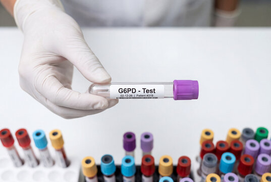 Medical professional in white glove holding g6pd test sample tube in laboratory