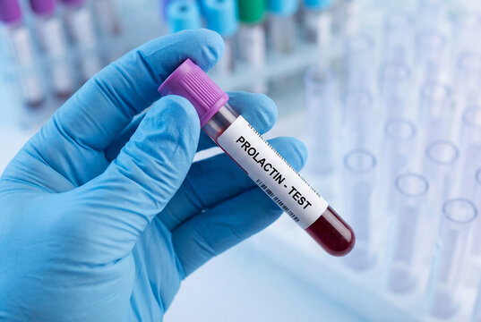 Medical professional in blue glove holding prolactin test blood sample tube
