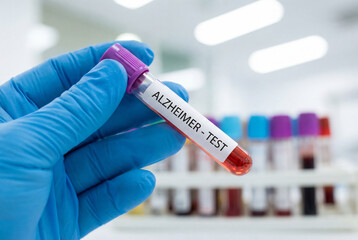 Fototapeta premium Alzheimer disease blood test sample tube held by a doctor in a medical laboratory