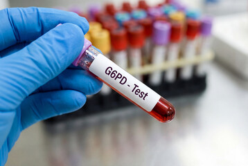 Obraz premium G6pd deficiency blood test sample held by a gloved hand in a medical laboratory