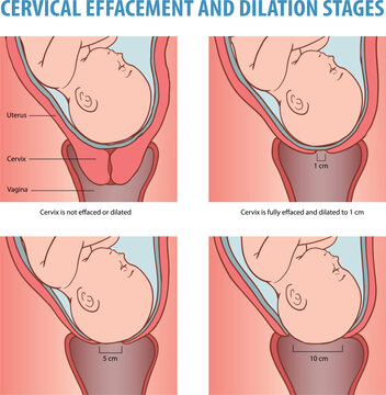 Cervical Effacement and Dilation Stages During Labor Illustration