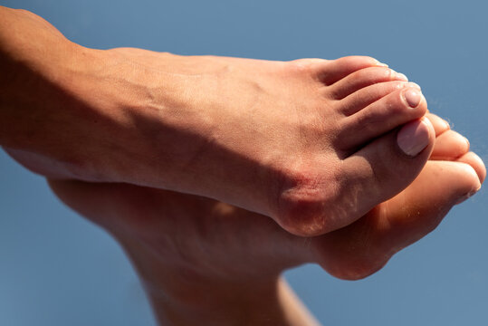 Hallux valgus deformity of big toe joint. Bare foot with Hallux valgus deformation. Human foot sole with deformities. Hallux Valgus on female legs close up. Feet of woman with hallux valgus.