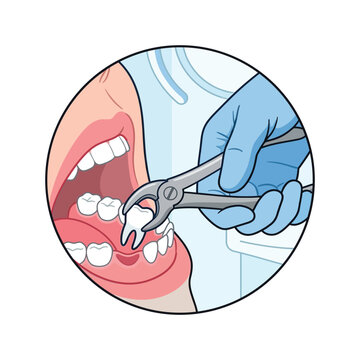 close up vector illustration of a doctor pulling out a patient's tooth