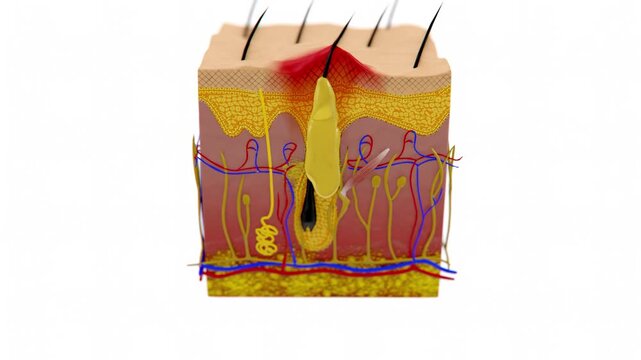 Skin anatomy showing acne | Acne Anatomy | Human Skin Acne Video