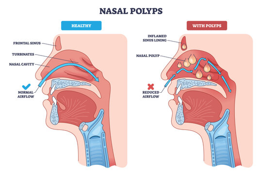 Nasal polyps brief overview showing healthy vs polyp-filled sinuses, with airflow arrows illustrating obstruction, key elements, nasal cavity, polyps, inflamed lining. Diagram