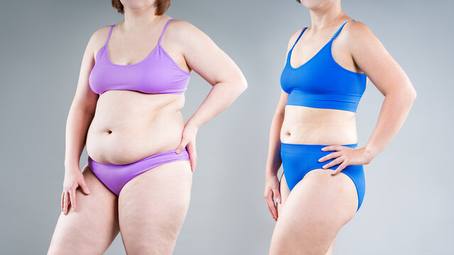 Before and after weight loss transformation, woman's fat body showing slimming results, liposuction, plastic surgery and tummy tuck