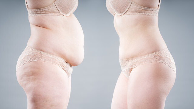 Before and after weight loss transformation, woman&rsquo;s fat body showing slimming results, liposuction, plastic surgery and tummy tuck