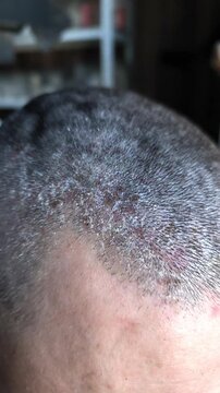 Close-up view of male scalp showing visible patches of dry skin and irritation caused by seborrheic dermatitis. condition affects scalp, causing flakes, redness. seborrhea concept. vertical