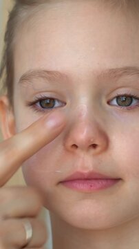 Close up of hand applies ointment to child face with atopic dermatitis. Portrait of girls face with allergy. Diathesis. Vertical shot