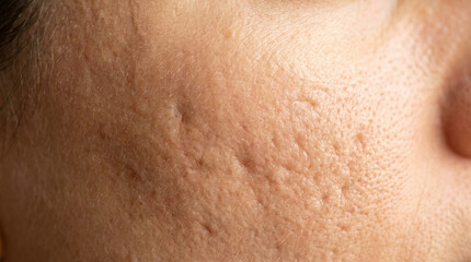 Fototapeta premium Close-up cheek with acne scars and uneven skin texture on neutral background with copy space words + concept