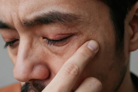 Man touches his red swollen eyelid showing infection or chalazion stye. Macro view of eye discomfort and inflammation. Painful symptom of barley condition.
