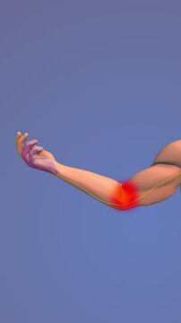 Cubital tunnel syndrome medical concept