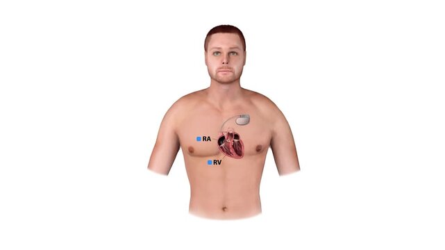 Implanted Pacemaker with Heart Chamber Labels in Human Chest for Cardiology Education and Patient Awareness
