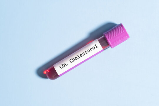 Blood sample tube with LDL cholesterol test label in medical laboratory over blue background.