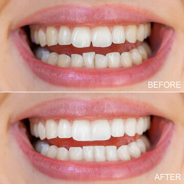 Before and after close-up of teeth alignment and whitening results