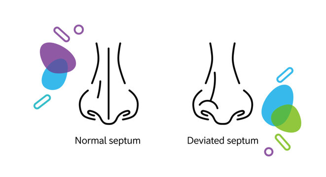Medical diagram comparing the front view of a nose with a normal straight septum and one with a deviated septum.