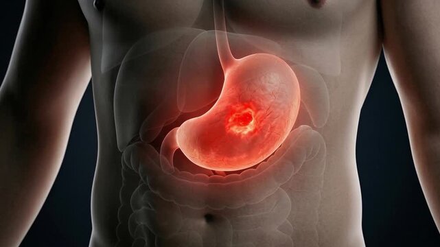 Human torso with transparent digestive system showing inflamed stomach ulcer inside the abdomen in medical view