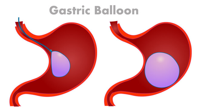 Gastric balloon sits inside your stomach, taking up space. For obesity, diabetes non surgical. Cross section anatomy, diagram. Digestion illustration vector