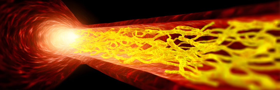 An artery that is tunnel-like and has yellow fat deposits narrows towards bright light in a microscopic view. Medical science concept of blockage.
