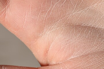 Fototapeta premium Man with dry skin on his hand against grey background, closeup