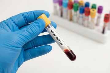 Naklejka premium Hand in blue glove holding NT probnp blood test tube