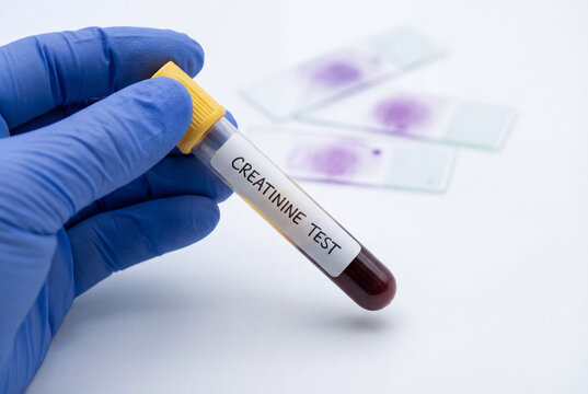 Hand in blue glove holding creatinine blood test sample tube
